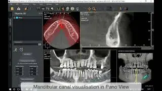 QuickVision 3D Tutorial - Mandibular Canal Drawing