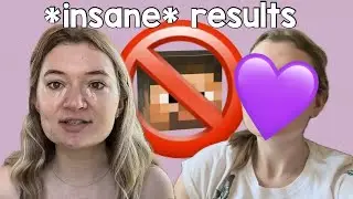 I got Masseter Botox for my Minecraft Jawline