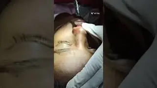 223. Nasal bone fracture reduction/repair of nasal fracture / closed reduction nasal fracture