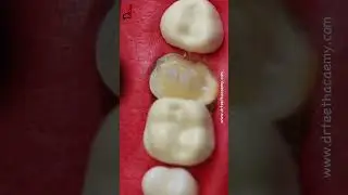 Deep cavity restoration 
