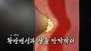[명의 의학백과📖] 황반변성과 삼출 망막박리