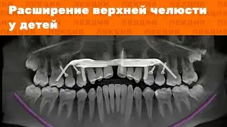 Расширение верхней челюсти у детей