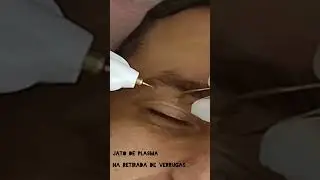 jato de plasma