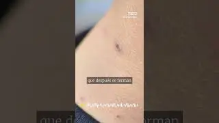 Pedro Gullón, director general de Salud Pública, cuenta cómo se manifiesta  MPOX