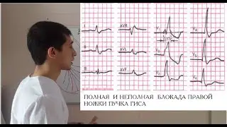 ПОЛНАЯ И НЕПОЛНАЯ БЛОКАДА ПРАВОЙ НОЖКИ ПУЧКА ГИСА!