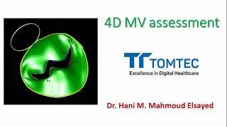 4D MV (Mitral Valve) assessment (TomTec)