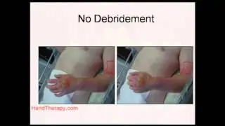 Burn Care
