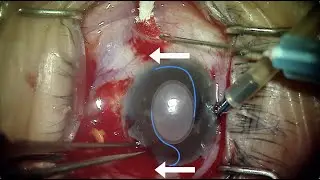Exchange of Haptic Fixated IOL with Excessive Tilt