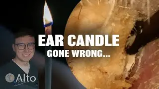 This Ear Candle Makes Hearing WORSE - Ear Wax Removal