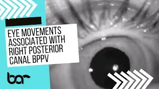 Right Posterior Canal BPPV with Epley Maneuver