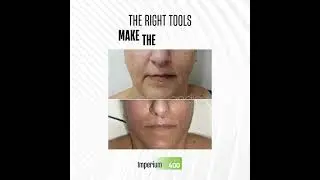 Excellent Facial Protocol with RF Diathermy by 𝗜𝗺𝗽𝗲𝗿𝗶𝘂𝗺 𝗺𝗲𝗱 𝟰𝟬𝟬.