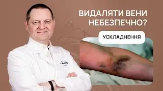 💉 ВАРИКОЗ | ВИДАЛЕННЯ ВЕН ЛАЗЕРОМ | УСКЛАДНЕННЯ