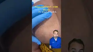 Massive lipoma Dr Khaled Sadek #skincare