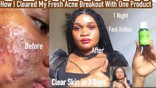HOW I USED ONE PRODUCTS TO CLEAR MY ACNE BREAKOUT I ONE  NIGHT