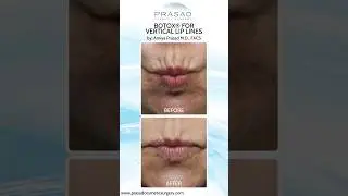 Treatments for Smokers Lines/ Vertical Lip Lines 