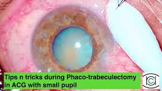 Tips and tricks during Phaco-trabeculectomy in ACG with small pupil