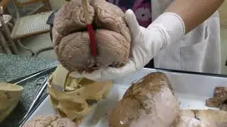 Anatomy Demonstration on Cerebral Duramater by Dr Renu Prasad