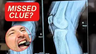 I Almost Missed This Rare Bone Condition (Knee Case @ ESSR 2024)