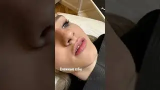 Сложные губ, Форма губ «Чайка» Одна процедура (1 мл) Juvederm 3