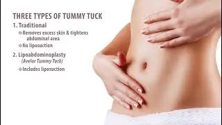 Three Types Of Tummy Tuck #TummyTuck