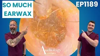 Gross but Satisfying! Deep Ear Wax & Skin Removal - EP1189