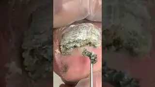 Black Moldy Toenail