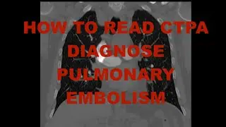 How to read a CTPA and diagnose a PE (CT pulmonary angiogram - pulmonary embolism)