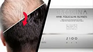 Tratamentul Crescina pentru regenerarea si stoparea caderii parului #Crescina
