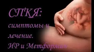 СПКЯ: симптомы и методы борьбы с ним. ИР, ГТТ и метформин