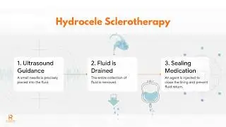 Hydrocele Treatment Without Surgery? — Explained