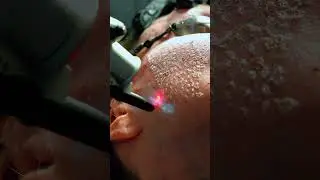 Watch this skin contract with an ablative CO2 Laser Treatment