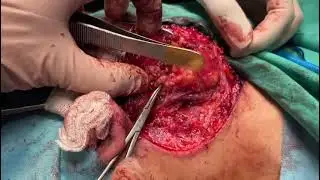 parotid tumors,Parotis tümörü