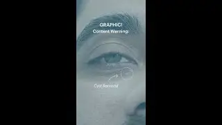 Content Warning: Cyst Removal