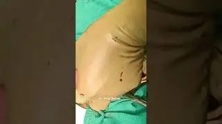 Vaginal myomectomy of submucous myoma.