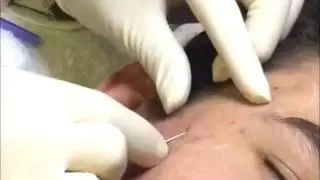 Subcision For Acne