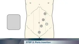 A step-by-step approach for totally robotic right hemicolectomy with intra-corporeal anastomosis