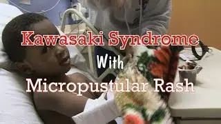 Kawasaki Syndrome with Micropustular Rash