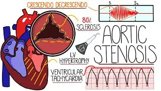 Aortic Stenosis Explained in 10 Minutes (With Heart Murmur Sound)