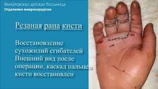 Восстановление сухожилий у детей, клинический пример