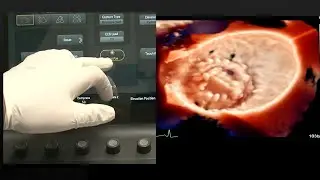 Live in-a-box case: 2D/3D-TEE for a Stuck Mitral mechanical prosthesis