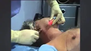 Laser assisted lipolysis