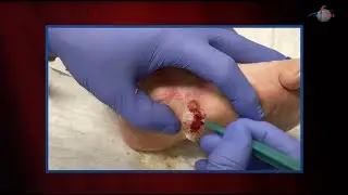 WCW: Debriding Callus from a Recurring Ulcer