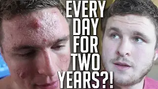 I Took Accutane Every Day For Almost 2 Years! (MY REVIEW)