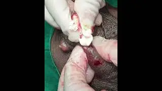 Popping Scrotal sebaceous cyst