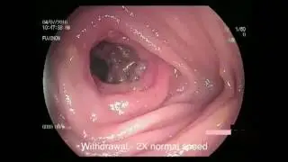 NSAID INDUCED SMALL BOWEL DIAPHRAGM DISEASE