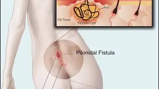 How to remove painful buttock cyst