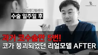 강남프로포즈메디컬센터 호치민, 과거 코수술만 5번으로 코가 붕괴되었던 리얼모델 방문 영상 After Rhinoplasty transformation!