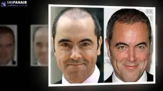 صور لمشاهير العالم قبل وبعد عمليات زراعة الشعر للحجز 00905555558555