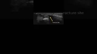 Metacarpal Fracture #POCUS Guided Ulnar Nerve Block and Reduction #pocus