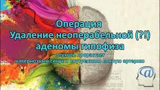 Операция. Удаление неоперабельной (?!) аденомы гипофиза. Нейрохирургия. Pituitary adenoma surgery